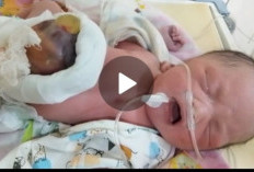 Belum Diambil Tindakan, Perut Bayi Umur 10 Hari Asal Empat Lawang Terbuka Disuruh  Pulang oleh RSMH